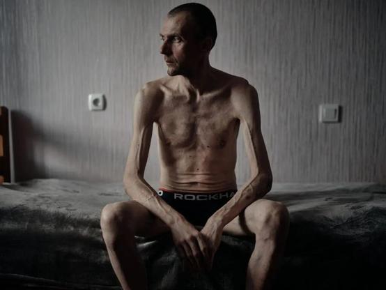 A Ukrainian soldier who returned from Russian captivity is photographed while undergoing rehabilitation in an unspecified location in Ukraine, summer 2025